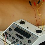 electro_acupuncture_Queens_NY_1