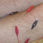 electro_acupuncture_Queens_NY_3